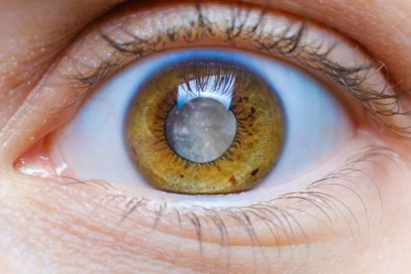 Tudo o que você precisa saber sobre catarata