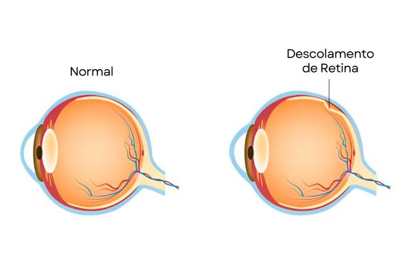 Descolamento de retina